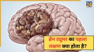 Brain Tumor