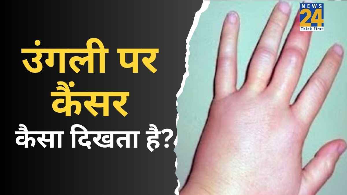 Finger Cancer Symptoms