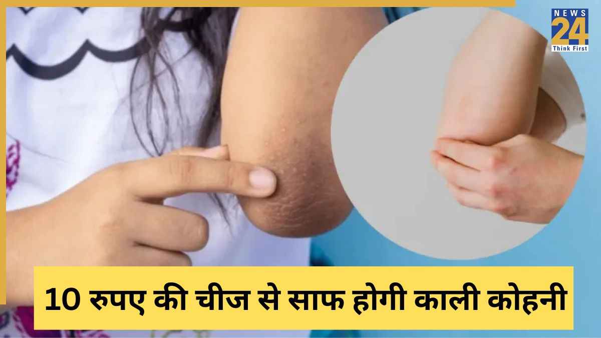 कोहनी का कालापन कैसे हटाएं? 10 रुपए में मिलने वाली इस चीज से काली कोहनी दिखने लगेगी साफ