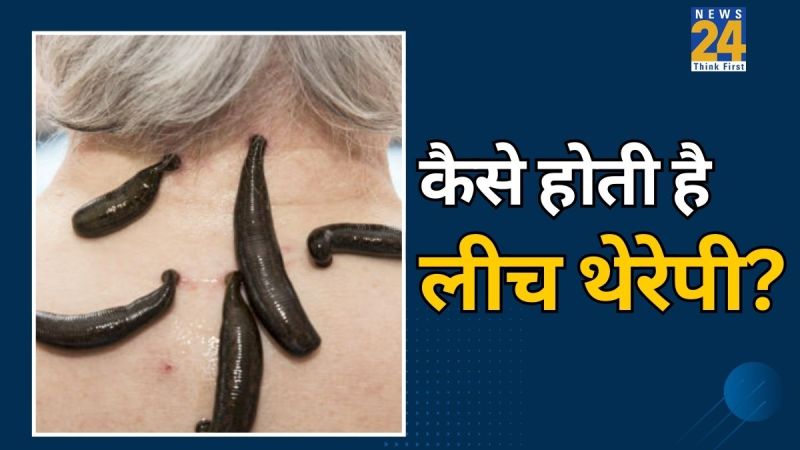 what is leech therapy in ayurveda