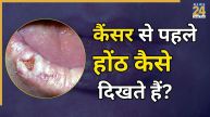 Lip Cancer Cracked Symptoms (1)