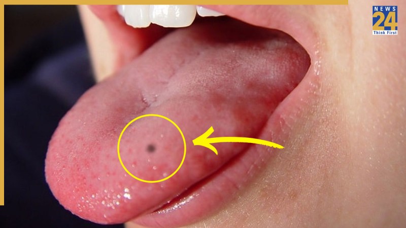 Mole On Tongue