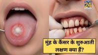 Muh Ke Cancer Ke Lakshan
