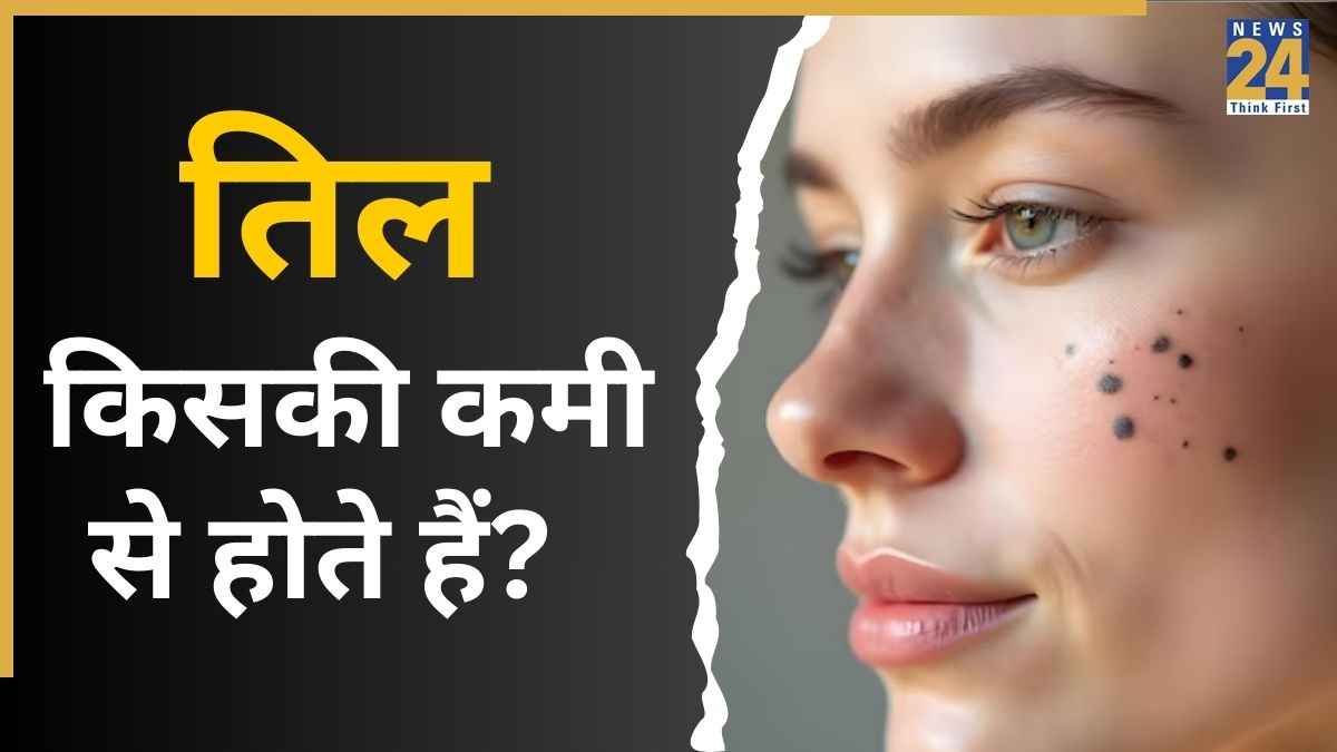 Moles on Face: चेहरे पर अचानक तिल होने का क्या मतलब है? डॉक्टर से जानें किसकी कमी का है संकेत