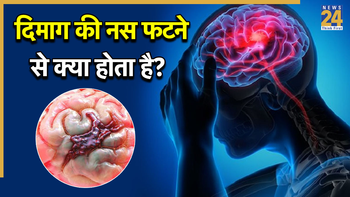 dimag ki nas fatne ki wajah dimag ki nas fatne ki wajah-1