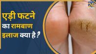 Cracked Heels Treatment