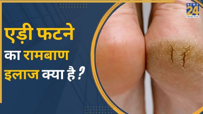 Cracked Heels Treatment