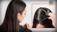 Dandruff Hair