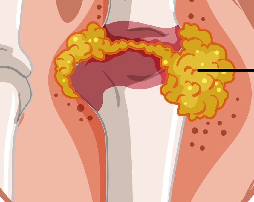 High Uric Acid-1-2-3