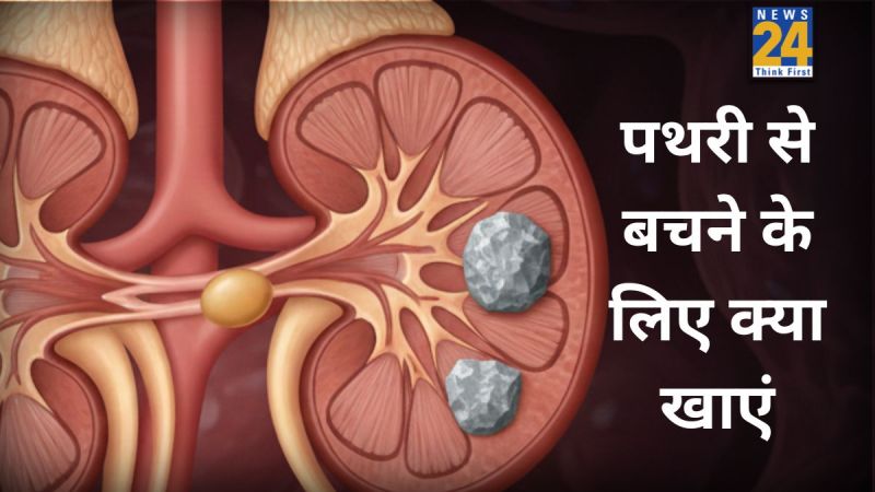 Kidney Stones Kidney Stones