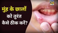 Mouth Ulcers