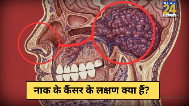 Naak Ke Cancer Ke Lakshan