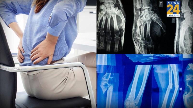 Osteoporosis In Young Age