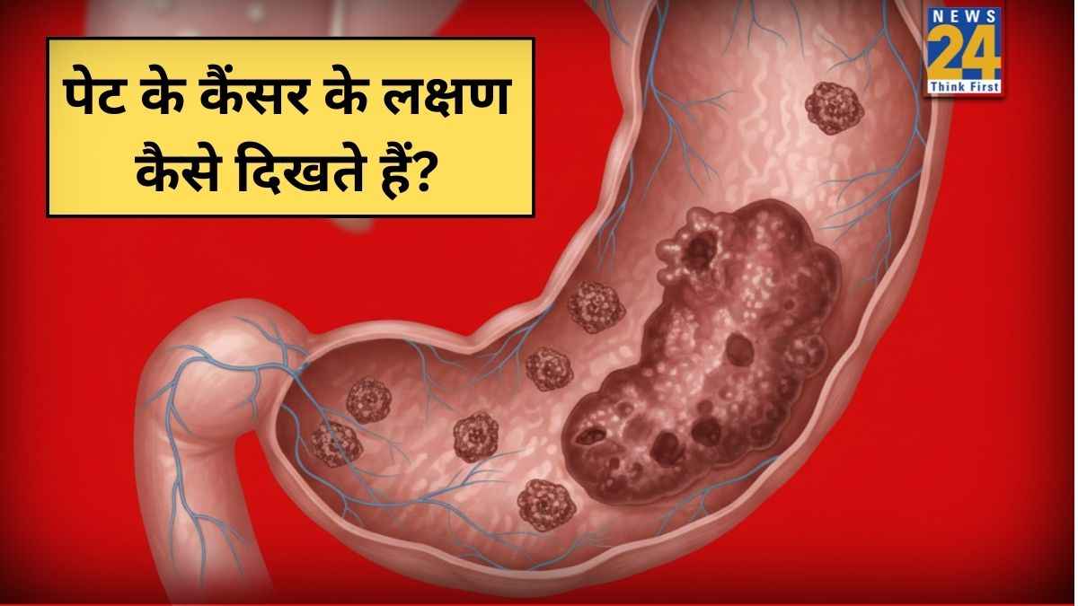 स्टेज 1 पेट कैंसर के क्या लक्षण हैं? महिलाओं में दिखते हैं Stomach Cancer के ये 5 वॉर्निंग साइन