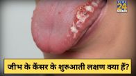 Tongue Cancer