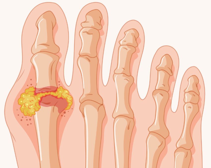 High Uric Acid-1-2-3-4