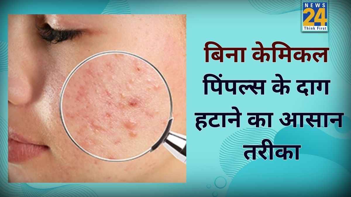 पिंपल्स के दाग से हैं परेशान? अपनाएं ये आसान घरेलू नुस्खे और पाएं कमाल का रिजल्ट