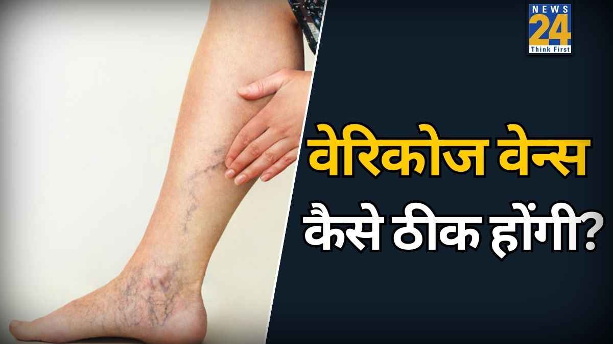 वेरिकोज वेन्स से परेशान हैं तो रोजाना बैठे-बैठे करें ये 3 एक्सरसाइज, पैरों पर नहीं दिखेंगी नीली-हरी धारियां