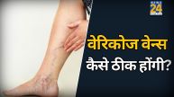 varicose veins