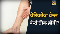 varicose veins