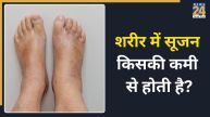 Body Swelling Home Remedies