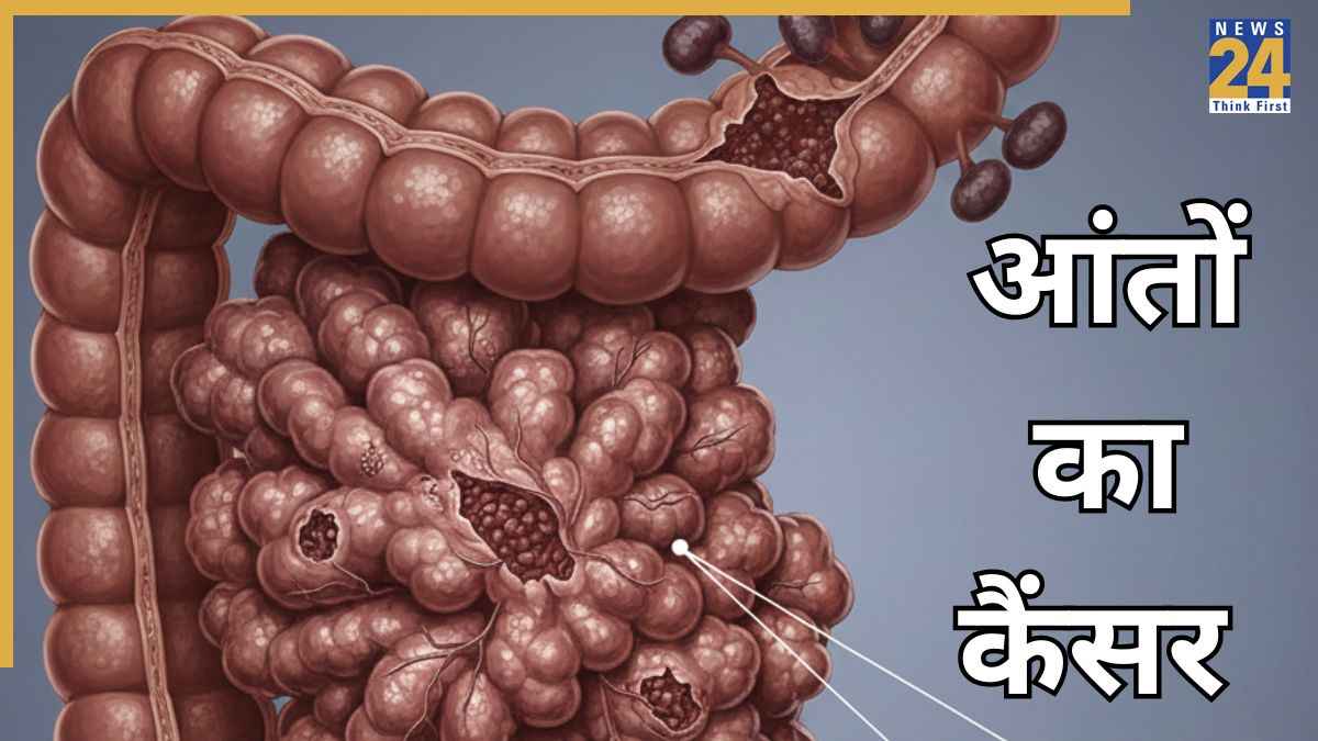 Colon cancer symptoms