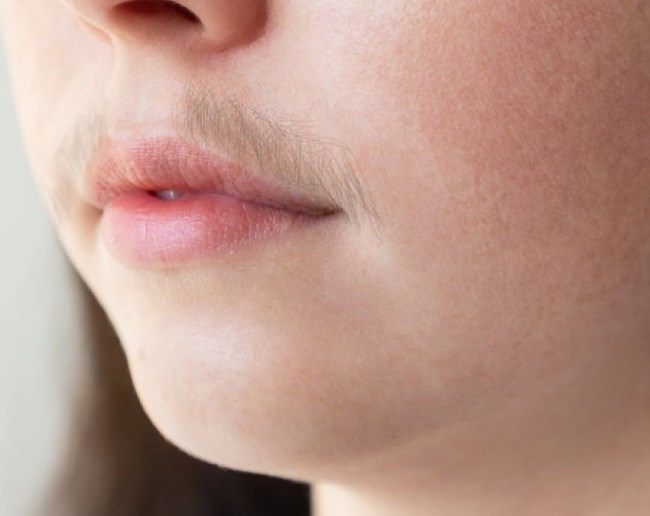 Hirsutism Kya Hota Hai Aur Iska Ilaj Kya Hai-1-2-3-4-5-6-7