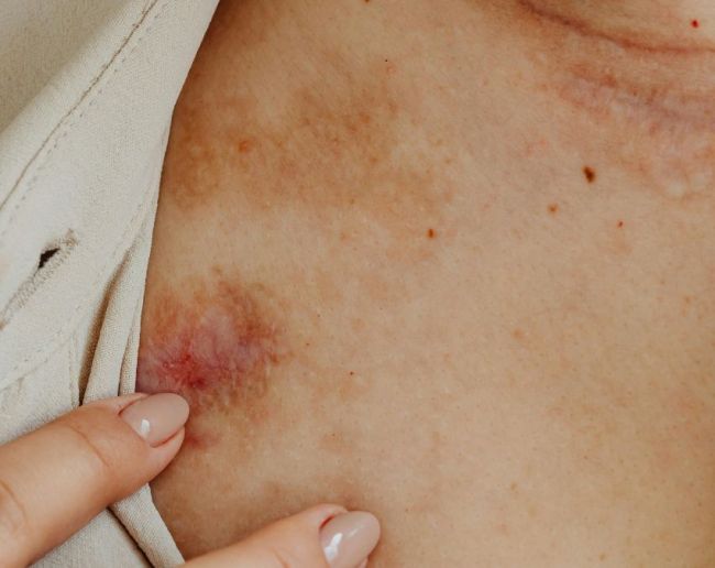 AIDS symptoms in women-1-2-3