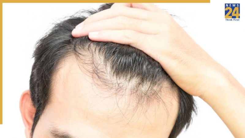 Hair Loss Causes In Young Men