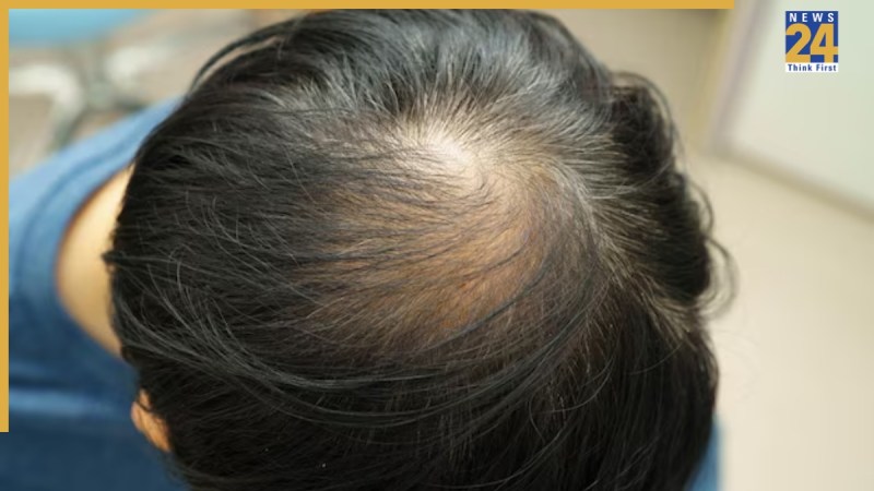 Hair Whorl On Head Meaning