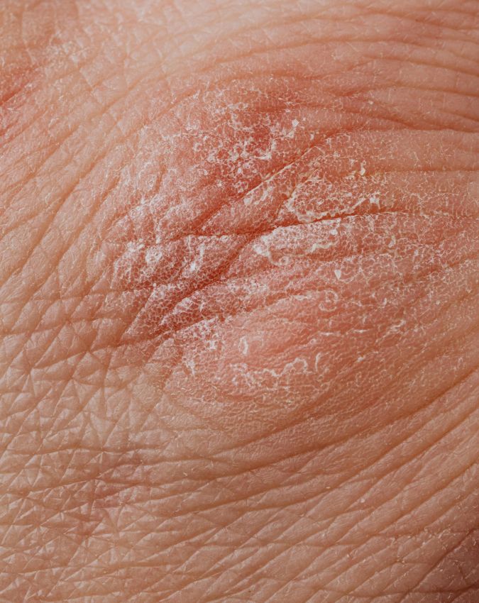 Khujli Kis Vitamin Ki Kami Se Hoti Hai Khujli Kis Vitamin Ki Kami Se Hoti Hai-1-2-3