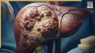 Liver Disease