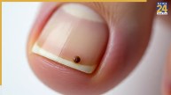 Mole on Toenail