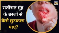 Mouth Sores Home Remedies