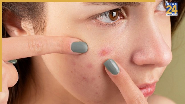 Pimples Due To Vitamin Deficiency