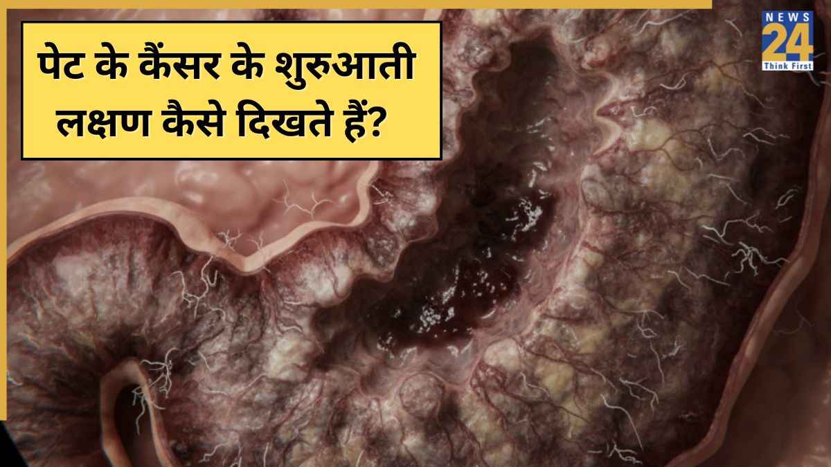 पेट के कैंसर के शुरुआती लक्षण क्या हैं? यहां जानिए Stomach Cancer की पहली स्टेज में कैसे संकेत आते हैं नजर