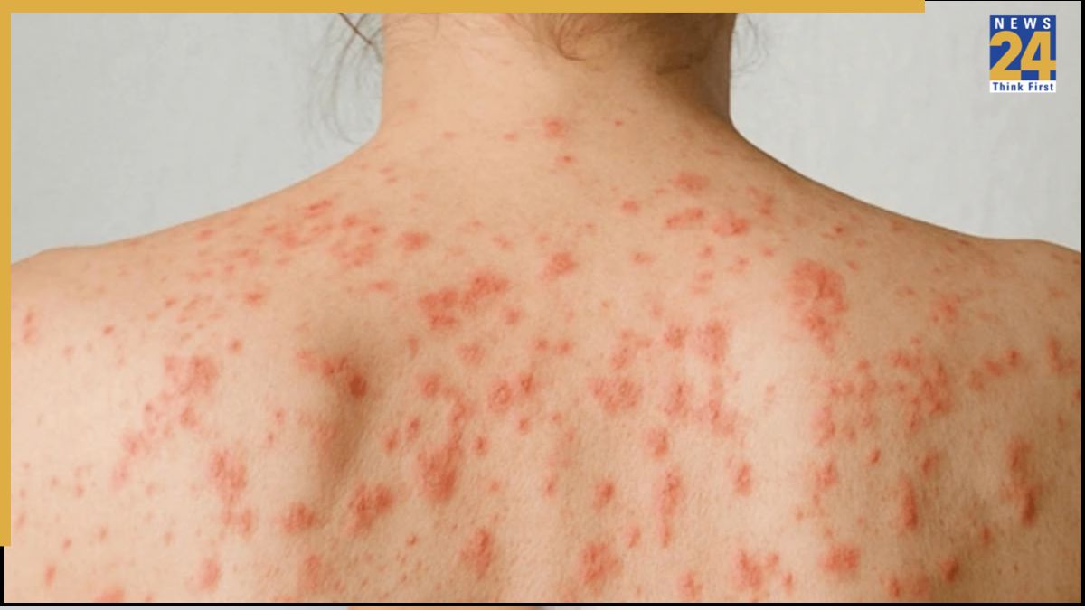 Skin Cancer Ke Lakshan Skin Cancer Ke Lakshan-1