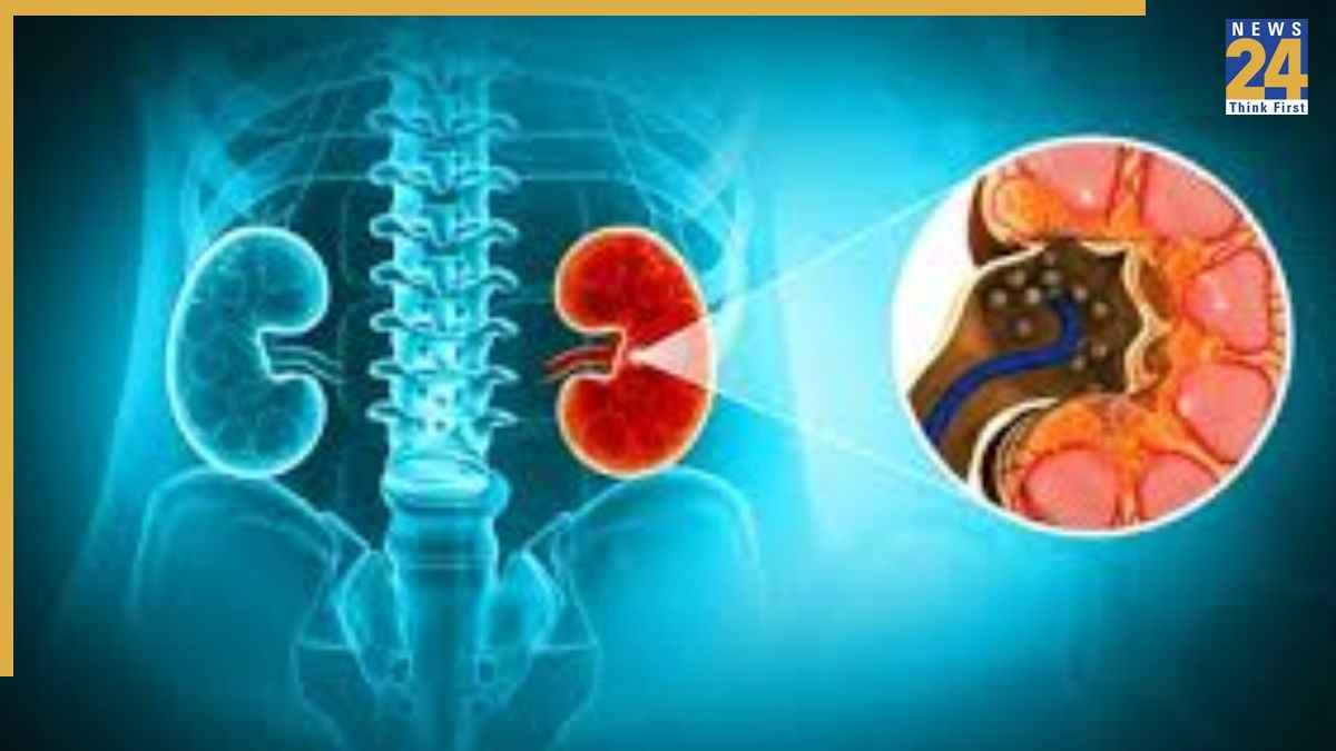 पथरी क्या है? आयुर्वेद डॉक्टर ने बताया शरीर में किसकी कमी से होती है पथरी