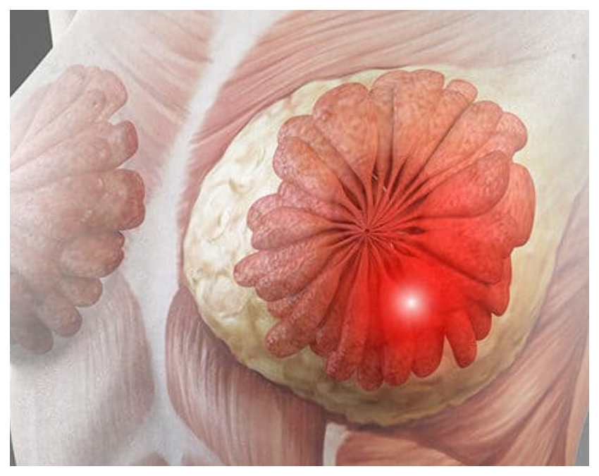 breast cancer symptoms -1-2-3-4-5-6-7