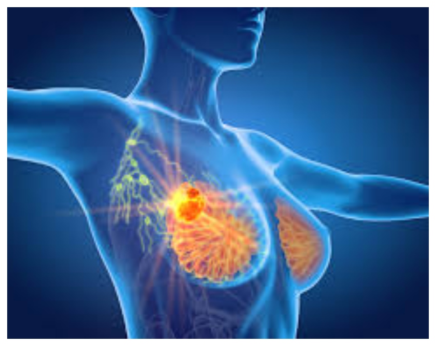 breast cancer symptoms -1-2