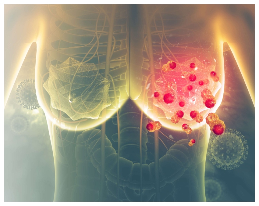 breast cancer symptoms -1-2-3-4-5-6