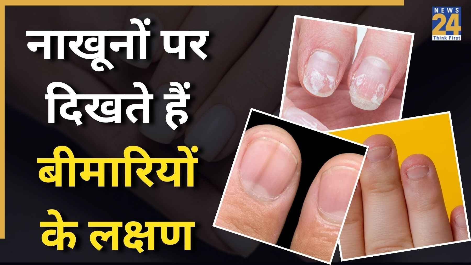 Disease Signs On Nails