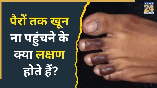 Blocked Arteries Symptoms In Legs