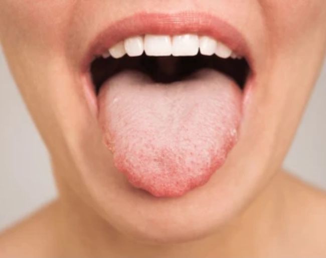 what causes the tongue to change colour-1-2-3