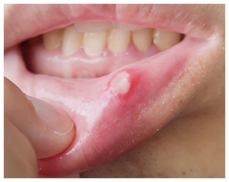 Mouth Cancer.jpg -1-2-3