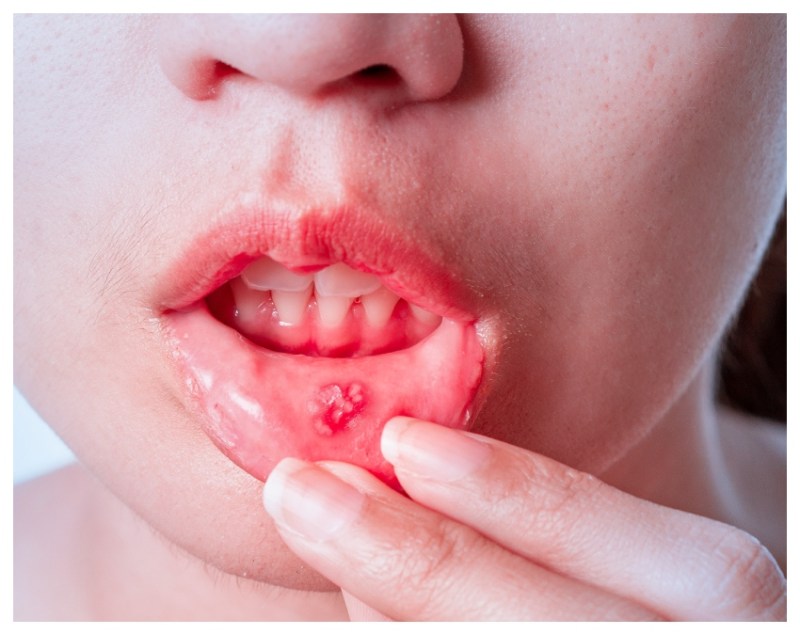 Mouth Cancer.jpg -1-2-3-4-5-6-7-8