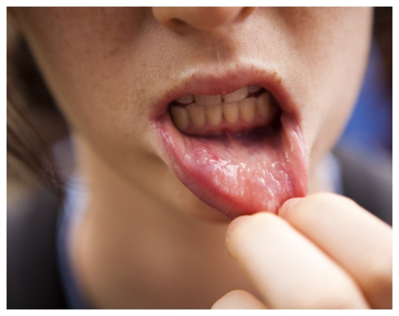 Mouth Cancer.jpg -1-2