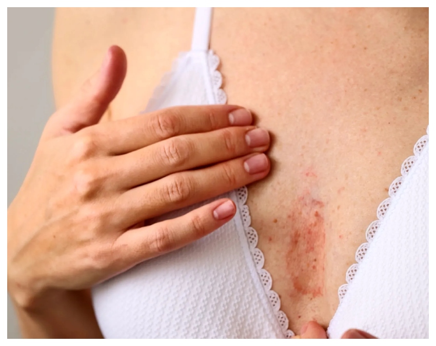 breast cancer symptoms -1-2-3-4