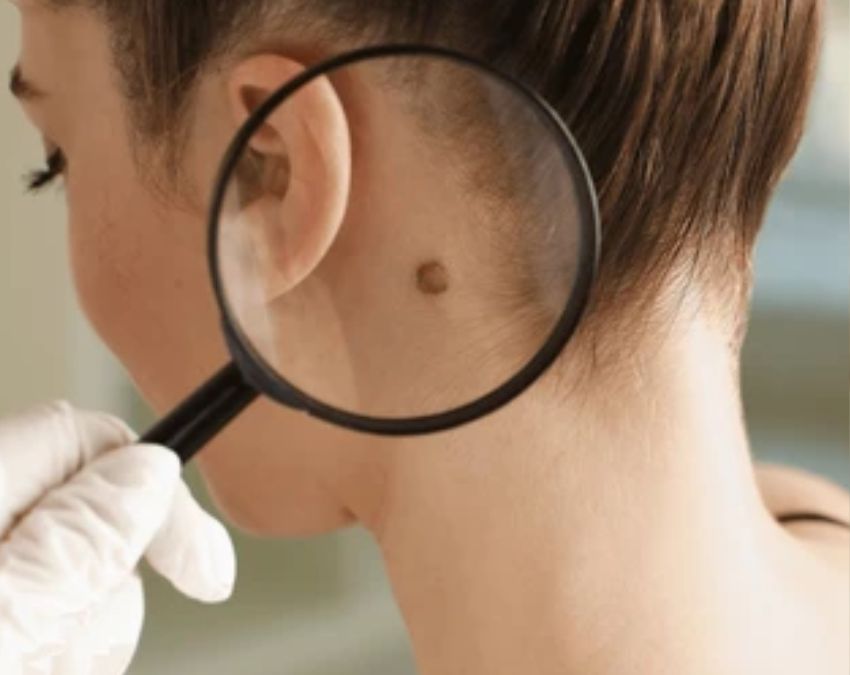 Skin Cancer Ke Lakshan Skin Cancer Ke Lakshan-1-2-3