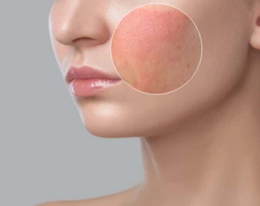 Skin Cancer Ke Lakshan Skin Cancer Ke Lakshan-1-2-3-4-5